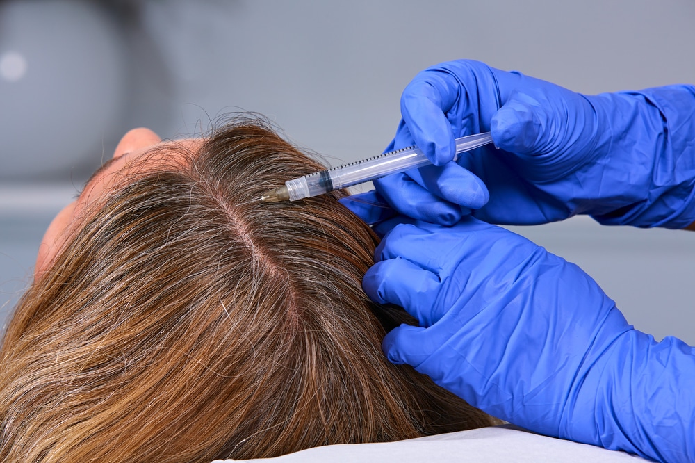A patient undergoes PRP treatment to promote thicker, healthier hair
