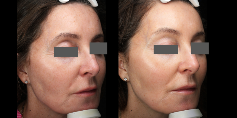 Before-and-after photos of a patient's face post-Polynucleotide treatment