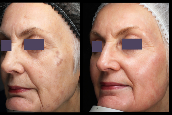 cosmelan patient before and after photos